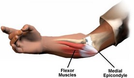 Golfer's elbow- sports chiropractor West Hollywood